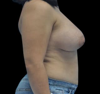 New Jersey Breast Augmentation Before & After Gallery - Patient 55432638 - Image 10