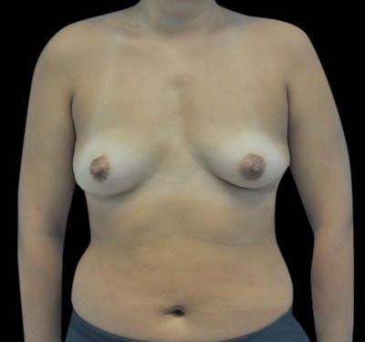 Breast Augmentation Before & After Gallery - Patient 55432640 - Image 1