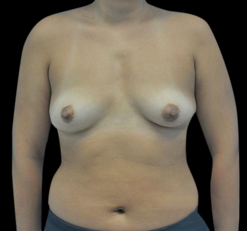 New Jersey Breast Augmentation Before & After Gallery - Patient 55432640 - Image 1