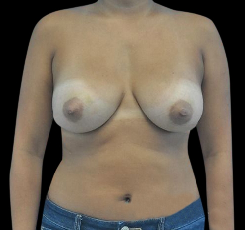 Breast Augmentation Before & After Gallery - Patient 55432640 - Image 2
