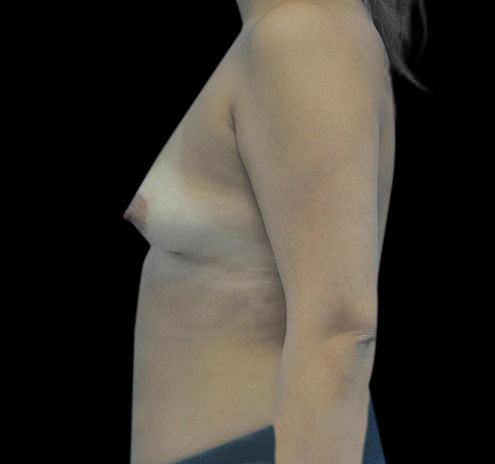 New Jersey Breast Augmentation Before & After Gallery - Patient 55432640 - Image 3