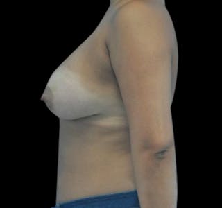 New Jersey Breast Augmentation Before & After Gallery - Patient 55432640 - Image 4