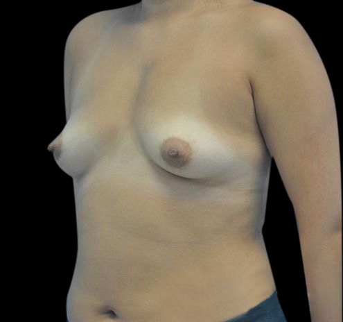 New Jersey Breast Augmentation Before & After Gallery - Patient 55432640 - Image 5