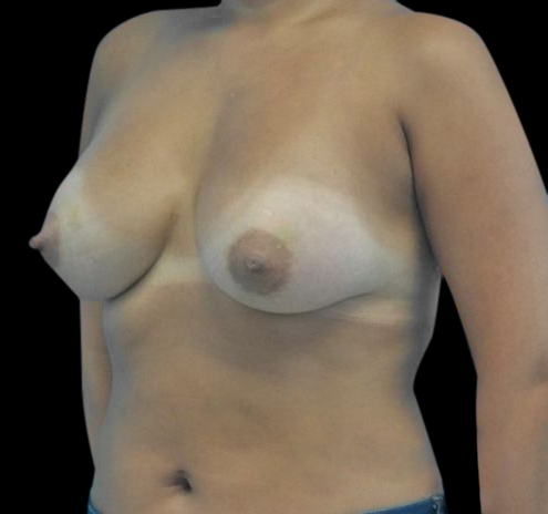 New Jersey Breast Augmentation Before & After Gallery - Patient 55432640 - Image 6