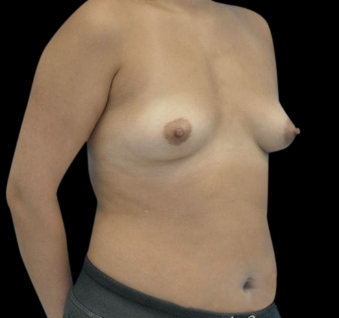 New Jersey Breast Augmentation Before & After Gallery - Patient 55432640 - Image 7