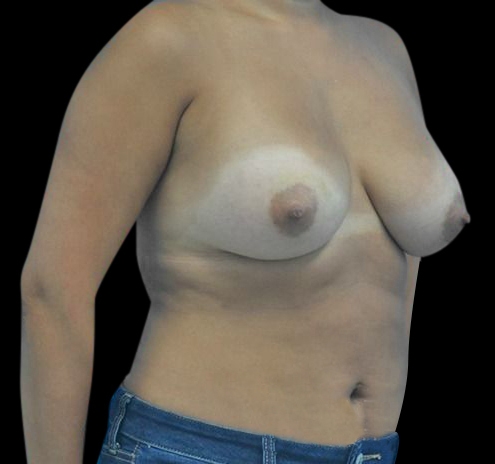 Breast Augmentation Before & After Gallery - Patient 55432640 - Image 8