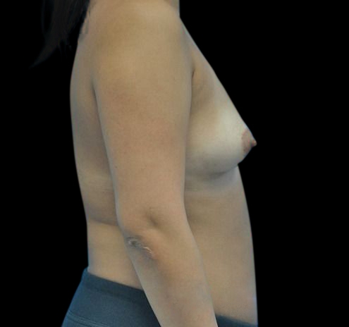 Breast Augmentation Before & After Gallery - Patient 55432640 - Image 9