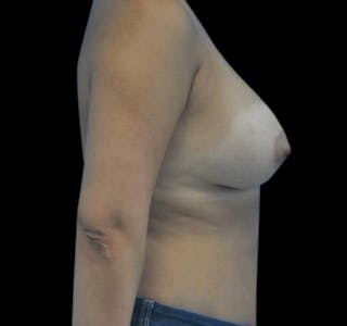 Breast Augmentation Before & After Gallery - Patient 55432640 - Image 10