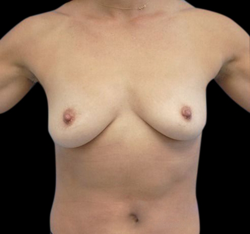 New Jersey Breast Augmentation Before & After Gallery - Patient 55432643 - Image 1