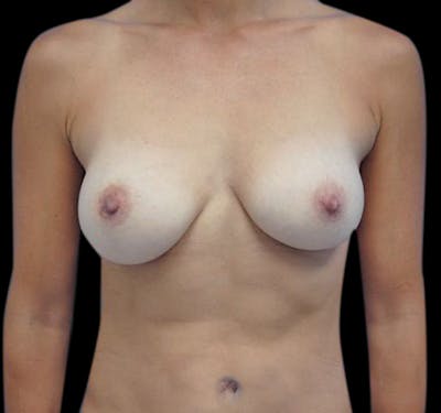 Breast Augmentation Before & After Gallery - Patient 55432643 - Image 2