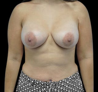 New Jersey Breast Augmentation Before & After Gallery - Patient 55432642 - Image 2