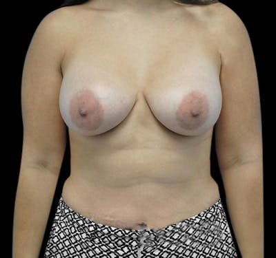 New Jersey Breast Augmentation Before & After Gallery - Patient 55432642 - Image 2