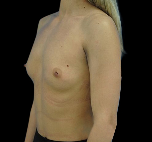 Breast Augmentation Before & After Gallery - Patient 55432650 - Image 1