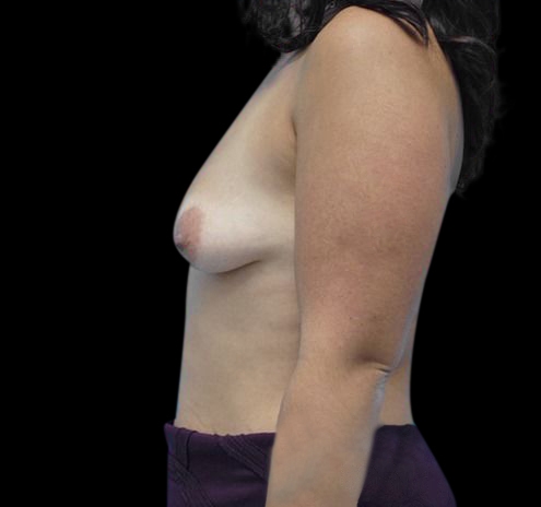 New Jersey Breast Augmentation Before & After Gallery - Patient 55432642 - Image 3