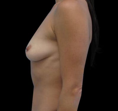 Breast Augmentation Before & After Gallery - Patient 55432643 - Image 3