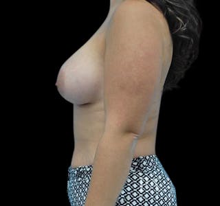 New Jersey Breast Augmentation Before & After Gallery - Patient 55432642 - Image 4