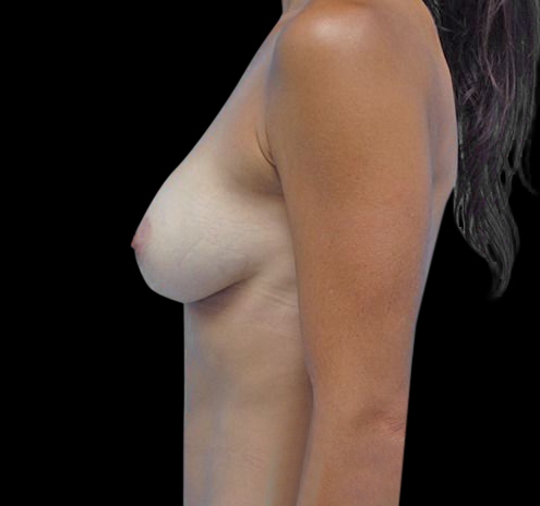 New Jersey Breast Augmentation Before & After Gallery - Patient 55432643 - Image 4