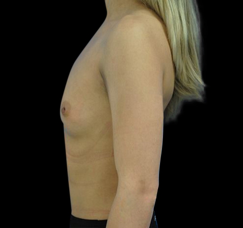 Breast Augmentation Before & After Gallery - Patient 55432650 - Image 3