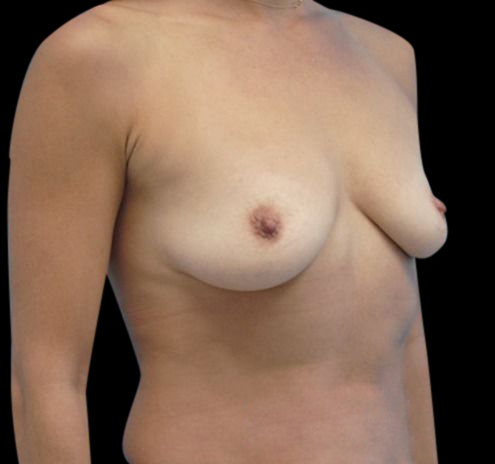 Breast Augmentation Before & After Gallery - Patient 55432643 - Image 7