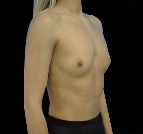 New Jersey Breast Augmentation Before & After Gallery - Patient 55432650 - Image 5