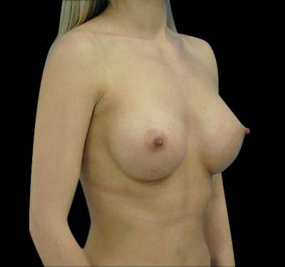 Breast Augmentation Before & After Gallery - Patient 55432650 - Image 6