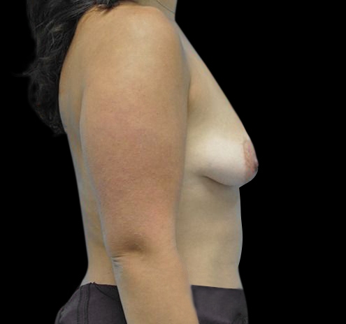 New Jersey Breast Augmentation Before & After Gallery - Patient 55432642 - Image 9