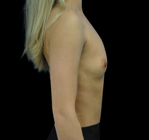 New Jersey Breast Augmentation Before & After Gallery - Patient 55432650 - Image 7