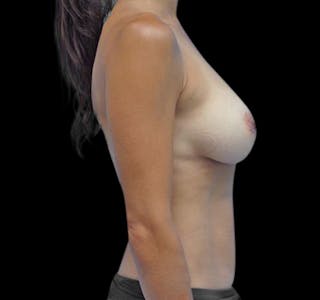 New Jersey Breast Augmentation Before & After Gallery - Patient 55432643 - Image 10