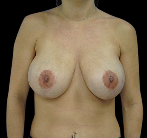 Revision Augmentation Before & After Gallery - Patient 55432653 - Image 1