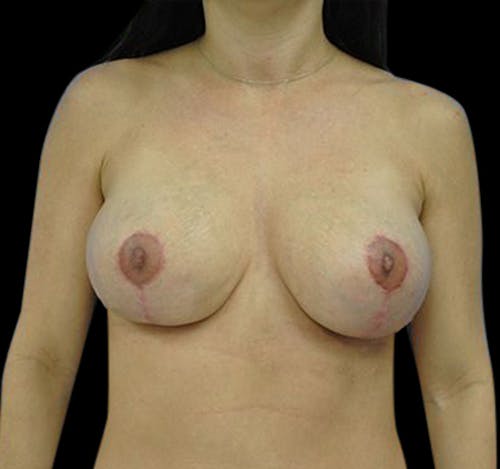 New Jersey Revision Breast Augmentation Before & After Gallery - Patient ICAS4mNESzOA8IBC-Rc6_Q - Image 2
