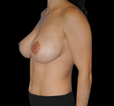 New Jersey Revision Augmentation Before & After Gallery - Patient 55432653 - Image 3