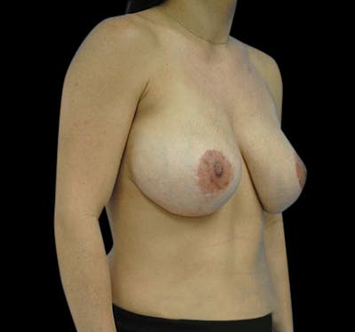 New Jersey Revision Augmentation Before & After Gallery - Patient 55432653 - Image 5