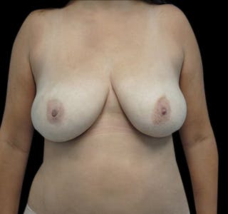 New Jersey Scar-Less Breast Reduction Before & After Gallery - Patient 55432656 - Image 2