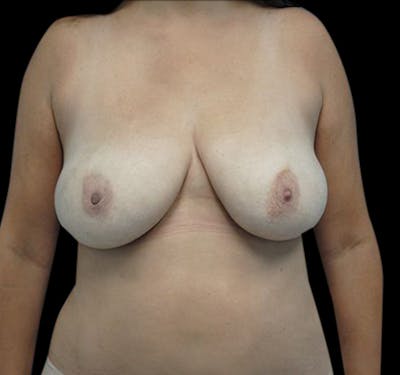 Scar-Less Breast Reduction Before & After Gallery - Patient 55432656 - Image 1