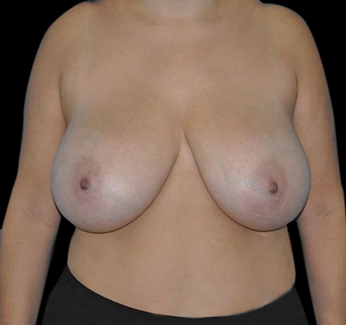 New Jersey Scar-Less Breast Reduction Before & After Gallery - Patient 55432656 - Image 1