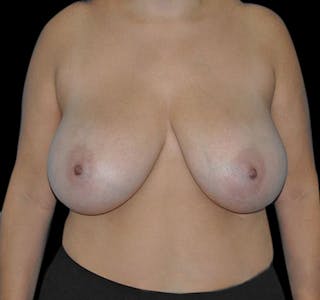 New Jersey Scar-Less Breast Reduction Before & After Gallery - Patient 55432656 - Image 2