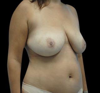New Jersey Scar-Less Breast Reduction Before & After Gallery - Patient 55432656 - Image 4
