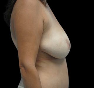 Scar-Less Breast Reduction Before & After Gallery - Patient 55432656 - Image 6