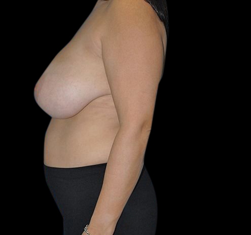 New Jersey Scar-Less Breast Reduction Before & After Gallery - Patient 55432656 - Image 9