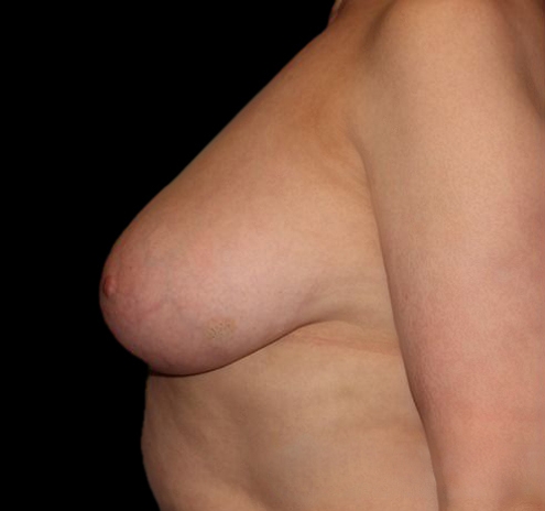 Scar-Less Breast Reduction Before & After Gallery - Patient 55432659 - Image 3