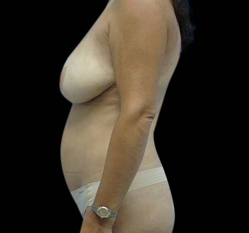 New Jersey Scar-Less Breast Reduction Before & After Gallery - Patient 55432656 - Image 10