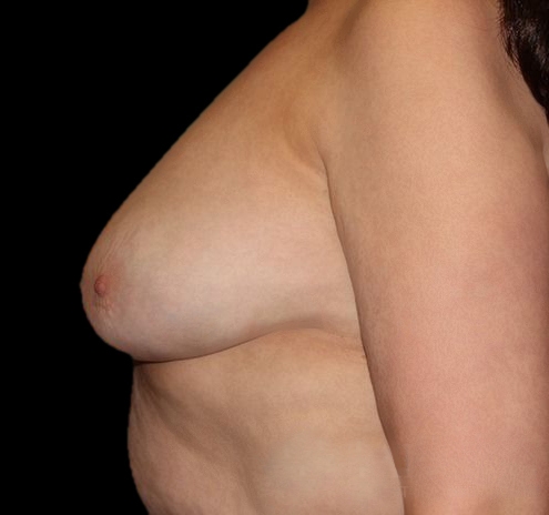 Scar-Less Breast Reduction Before & After Gallery - Patient 55432659 - Image 4