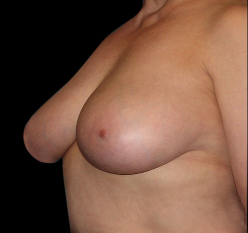 Scar-Less Breast Reduction Before & After Gallery - Patient 55432659 - Image 5