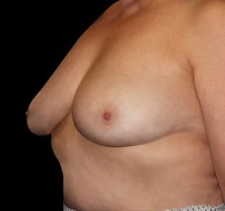 New Jersey Scar-Less Breast Reduction Before & After Gallery - Patient 55432659 - Image 6