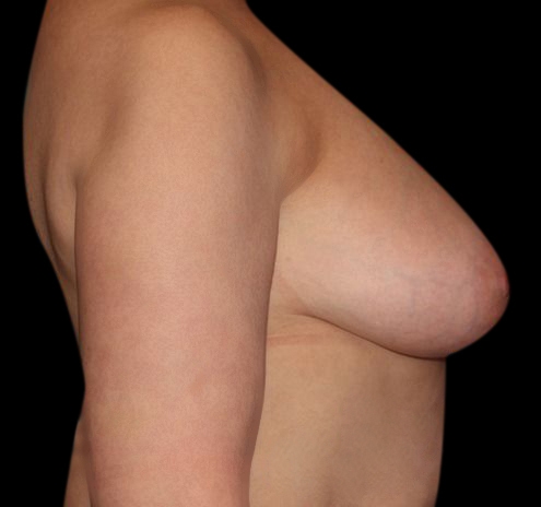 Scar-Less Breast Reduction Before & After Gallery - Patient 55432659 - Image 7