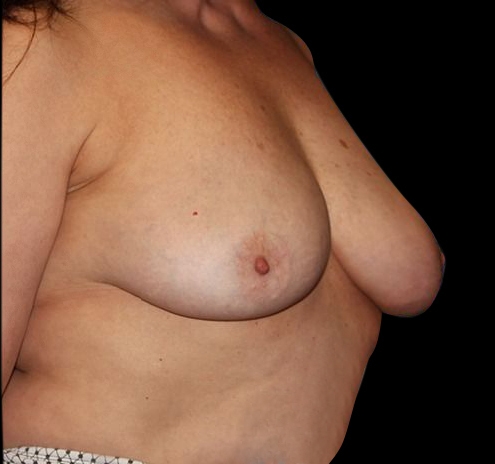 Scar-Less Breast Reduction Before & After Gallery - Patient 55432659 - Image 10