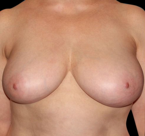 New Jersey Scar-Less Breast Reduction Before & After Gallery - Patient 55432659 - Image 1