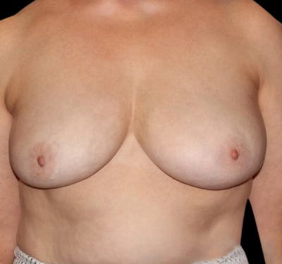 New Jersey Scar-Less Breast Reduction Before & After Gallery - Patient 55432659 - Image 2