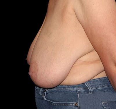 Scar-Less Breast Reduction Before & After Gallery - Patient 55432663 - Image 3