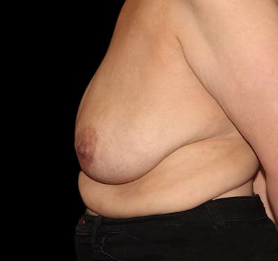 New Jersey Scar-Less Breast Reduction Before & After Gallery - Patient 55432663 - Image 4